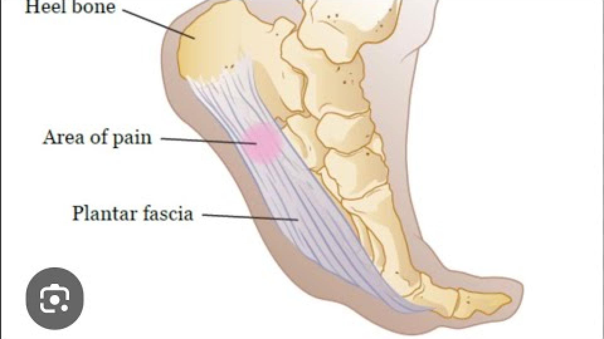 How to help symptoms of plantar fasciitis